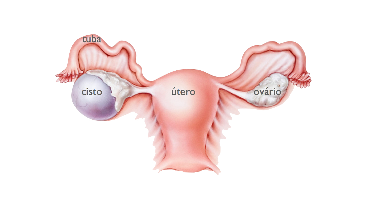 cisto